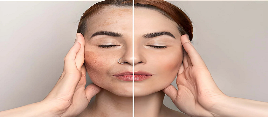 Best Pigmentation Treatment in Andheri, Mumbai
